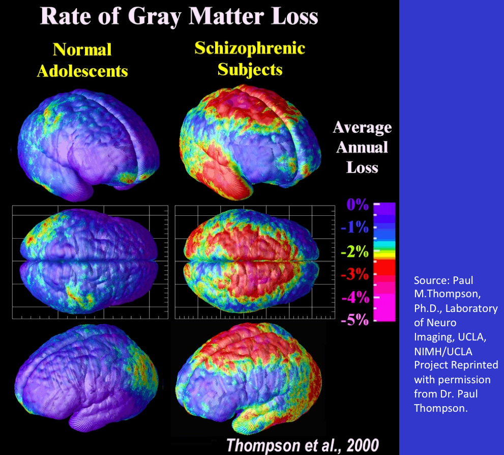 Schizophrenia Brain Scan Vs Normal Mri Scan Detects Signs Of Schizophrenia Brain Imaging
